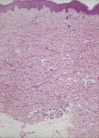 Histological section of human skin showing epidermis, dermis and hypodermis
